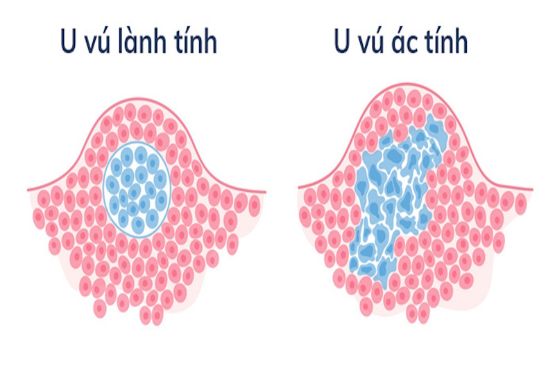U Vú Lành Tính: Dấu Hiệu, Chẩn Đoán Và Phương Pháp Điều Trị Hiệu Quả