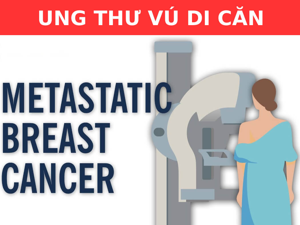 Ung Thư Di Căn Hạch Nách Có Chữa Được Không? Hiểu Rõ Và Tìm Phương Pháp Điều Trị