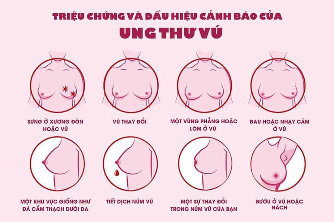 Dấu hiệu của ung thư vú và phương pháp điều trị